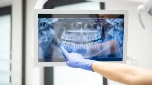 What is the Cost of a Dental X-ray?
